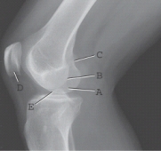 <strong>Which one of the labeled structures is the medial condyle of the femur? </strong> A) A B) B C) C D) D E) E