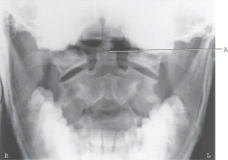 <strong>This radiographic image represents which of the following projections and/or positions? </strong> A) AP Fuchs method B) AP pillar projection C) AP axial C spine projection D) AP open-mouth projection