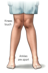 You are assessing a toddler who has just learned how to walk. Look at the picture and identify the type of legs that are normally seen in this age group. It is called _________ ___________.