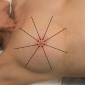 <strong> In the accompanying figure, what is the breast palpation technique pattern for assessing the breasts?</strong> A) Vertical strip pattern B) Radial spoke pattern C) Circular pattern D) Bimanual pattern