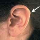 <strong> You are assessing an ear and see this deviation. What is the name of the assessment finding shown in the photo?</strong> A) Cyst B) Darwin tubercle C) Tophi D) Tragus