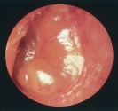 <strong> You are performing an inner ear assessment. What is your assessment finding based on the photo above?</strong> A) Normal finding B) Otitis media C) Ruptured tympanic membrane D) Cerumen buildup