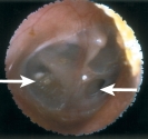 <strong> The patient comes to urgent care complaining of ear pain. You assess the ear using an otoscope. What is your assessment finding?</strong> A) Otitis media B) Normal finding C) Ruptured tympanic membrane D) Cerumen