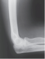 -An abnormal supinator sign seen on the elbow radiograph would most likely be correlated with what mechanism of injury?