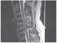 -Refer to the figure. The anterolisthesis of C6 on C7 has resulted in abnormal compression of the: