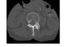 -Musculoskeletal CT scanning is typically done with: