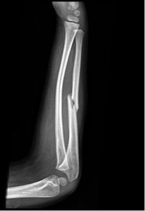 <strong> -Refer to the figure. The deformity of the radius is known as:</strong> A) Plastic bowing B) Greenstick fracture C) Torus fracture D) Complete midshaft fracture