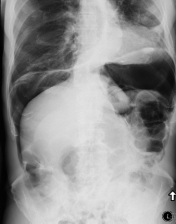 <strong> This image shows a patient who:</strong> A) needs a colonoscopy for diagnosis. B) has a perforated viscus. C) has a cirrhotic liver. D) can be treated with IV antibiotics.