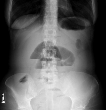 <strong> The patient in this image suffers from:</strong> A) a small bowel obstruction. B) a large bowel obstruction. C) free intraperitoneal air. D) appendicitis.