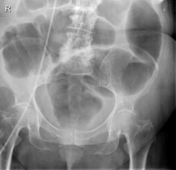 <strong> There is an obstruction in this patient's:</strong> A) mid-small bowel. B) rectum. C) mid colon. D) ileocecal valve.
