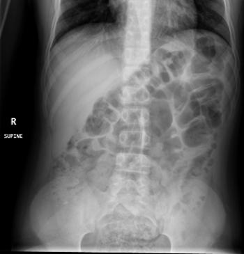 <strong> There is a very small but important finding in this patient with acute abdominal pain: What is it?</strong> A) A calcified gallstone B) Large bowel obstruction C) Appendicolith D) Free intraperitoneal air