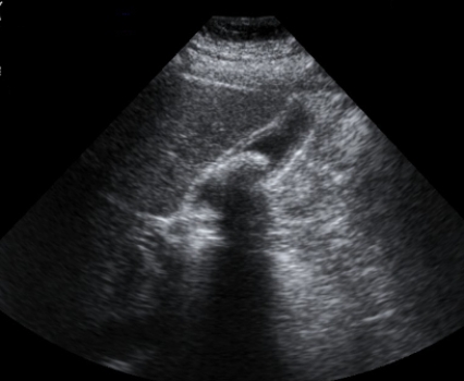<strong> This ultrasound image shows that this patient has:</strong> A) liver cancer. B) cholelithiasis. C) liver cyst. D) blood in Morrison's (hepatorenal) pouch.