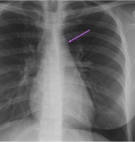 <strong> In this AP projection the arrow indicates:</strong> A) a normal arch of aorta. B) a dilated pulmonary trunk. C) an enlarged tracheobronchial lymph node. D) a trachea shifted to left due to mass effect.