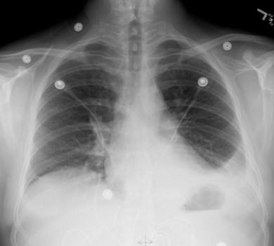 <strong> This portable AP chest radiograph shows a patient with:</strong> A) acute pulmonary edema. B) left lower lobe pneumonia without pleural effusion. C) a left pleural effusion. D) bronchogenic carcinoma in the lingula of the left upper lobe.