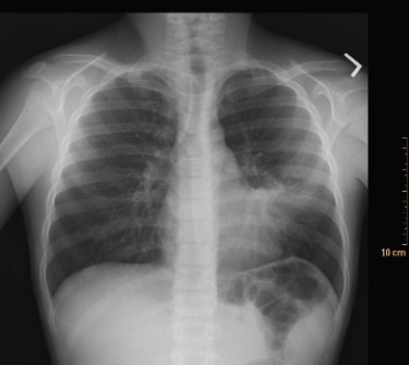 <strong> What condition does the image depict?</strong> A) Pneumothorax B) Pleural effusion C) Bacterial pneumonia D) Congestive heart failure