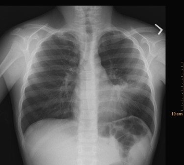 <strong> This image includes a classic radiographic finding. What is the name of this radiologic sign, and what is the most likely disease?</strong> A) Reticulonodular pattern; interstitial lung disease B) Silhouette sign; pneumonia C) Cephalization of the pulmonary vascular pattern; congestive heart failure D) Silhouette sign; metastatic malignancy