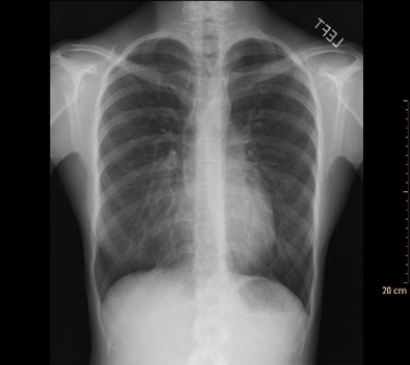 <strong> This frontal radiograph suggests an increase in lung density associated with an apparent silhouette sign along the right border of the heart. However, after a lateral view was also examined, the radiologist concluded that the patient's lungs were normal. Why?</strong> A) The radiograph is an AP rather than the normal PA view. B) The patient has fibrous granulomas. C) The patient has pectus excavatum. D) The patient is recovering from heart bypass surgery.