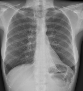 <strong> Based on the image, what does this patient likely have?</strong> A) Left lower lung atelectasis B) Perforated left hemidiaphragm C) Left pleural effusion D) Paraspinal mass