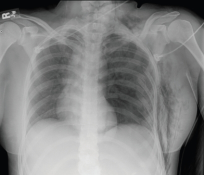 <strong> This patient is suffering from which symptoms?</strong> A) Fever and cough B) Trauma and limited air exchange on the left C) Abdominal pain; preoperative radiograph D) Known metastatic diseases and mediastinal adenopathy