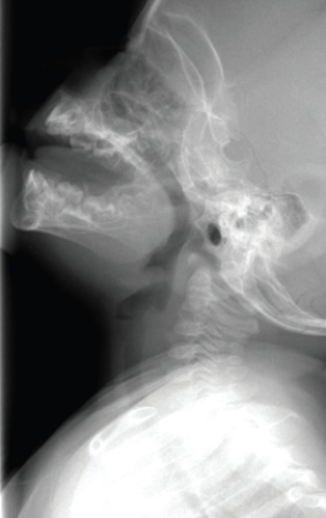 <strong> This image shows a child with:</strong> A) allergies and enlarged adenoids causing snoring. B) an (potentially fatal) acute epiglottitis. C) failure to thrive and chronic dysphagia. D) a viral illness that will respond readily to conservative treatment.