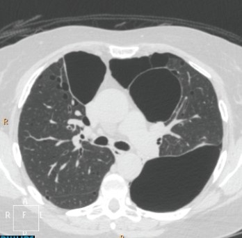 <strong> The axial CT shown depicts that this patient has which disease?</strong> A) Emphysema B) Interstitial lung disease C) Nodular lung disease D) Pneumothorax