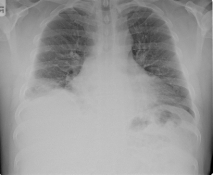 <strong> Based on the image, what treatment will the patient likely receive?</strong> A) Chemotherapy B) Cardiac transplant C) Surgery D) Antibiotics