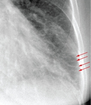 <strong> The red arrows in this image highlight a finding that is associated with:</strong> A) congestive heart failure. B) pneumonia. C) silicosis. D) emphysema.