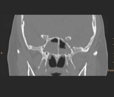 <strong> This coronal image from paranasal sinus CT depicts a patient with:</strong> A) mucoperiosteal thickening and fluid in the sphenoid sinus. B) invasive squamous cell carcinoma of the maxillary sinus. C) temporalis muscle calcification indicating the presence of temporal arteritis. D) an incidental pituitary macroadenoma.