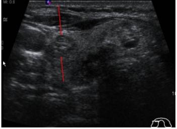 <strong> This image is a transverse ultrasound scan of a thyroid gland. The structure indicated by the red arrows is:</strong> A) the trachea. B) a thyroid nodule. C) the common carotid artery. D) a parathyroid gland.