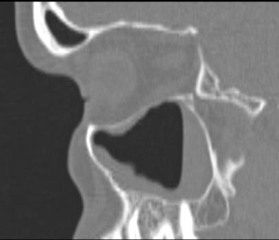 <strong> Based on this sagittal CT, you can conclude that the patient:</strong> A) was upright when the CT was done and has circumferential mucoperiosteal thickening of the maxillary sinus. B) was supine when the CT was done and the patient has fluid in the dependent portion of the maxillary sinus. C) has had a blowout fracture of the orbit. D) has a maxillary sinus tumor.