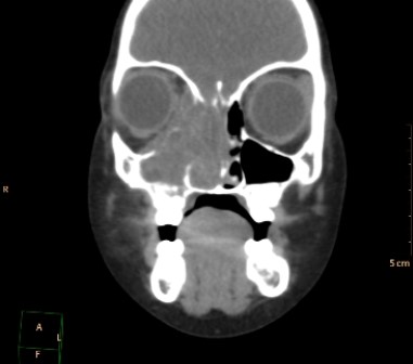 <strong> This CT scan depicts a patient with:</strong> A) right maxillary and right-sided ethmoid sinusitis. B) acute right orbital blow-out fracture with hematoma in the right orbit. C) right-sided invasive sino-nasal tumor that involves the orbit. D) commonly seen asymmetry in the development of the paranasal sinuses.