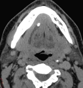 <strong> Based on this axial CT, this patient would likely:</strong> A) have pain when eating. B) need immediate surgery because of epiglottitis. C) have had a stroke because of an occluded vertebral artery. D) have dental pain because of an abscessed incisor.