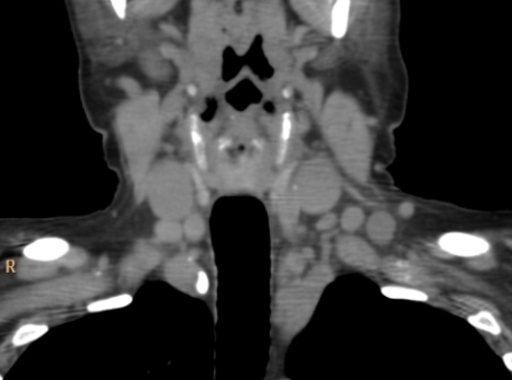 <strong> This coronal CT shows:</strong> A) a patient with severe dyspnea. B) a patient with lymphoma. C) a patient with chronic dysphagia. D) a patient with cervical pain.