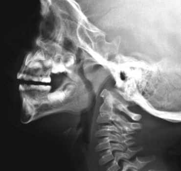 <strong> This image shows a pediatric patient that has:</strong> A) a maxillary sinus abscess. B) enlarged adenoids. C) epiglottitis. D) periodontal abscess.