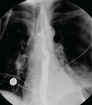 <strong> The esophagram shows a patient with:</strong> A) progressive dysphagia caused by esophageal cancer. B) regurgitation of undigested food from a Zenker's diverticulum. C) tracheobronchial fistula. D) hiatal hernia and GERD.