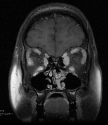 <strong> This contrast-enhanced coronal MRI of the orbits shows a finding related to one of the extraocular muscles associated with:</strong> A) trauma. B) acute onset of blindness. C) Graves' disease. D) strabismus.