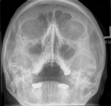<strong> Based on this image, this patient is being followed for which of the following?</strong> A) Response to radiation therapy for a paranasal sinus tumor B) Response to medical treatment for acute sinusitis C) Reaction to the inhalation of noxious fumes D) Post-surgical complications after sinus surgery
