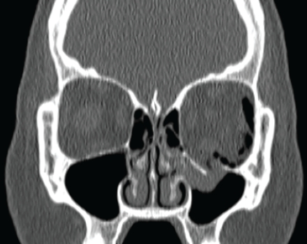<strong> This coronal CT depicts a patient who:</strong> A) caught a softball with her left eye. B) has a left nasal tumor. C) has seasonal sinus allergies. D) has exophthalmos.