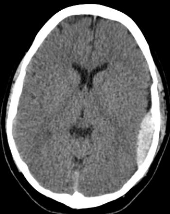 <strong> This image reveals the presence of:</strong> A) an epidural hematoma. B) a subdural hematoma. C) an acute ischemic stroke. D) subarachnoid hemorrhage.