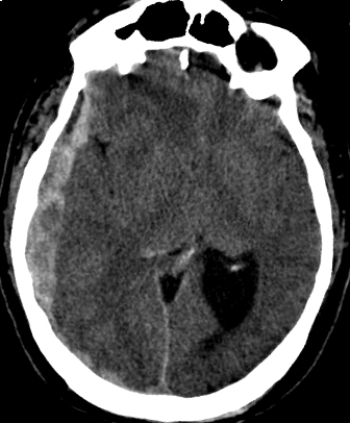 <strong> The patient in this image has which of these conditions?</strong> A) An epidural hematoma B) A subdural hematoma C) An acute ischemic stroke D) A subarachnoid hemorrhage