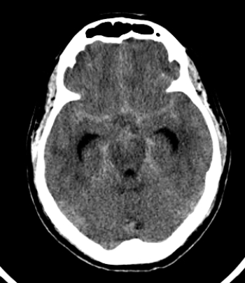 <strong> The pathology shown in the image above is associated with:</strong> A) chronic headache. B) acute onset of aphasia. C) chronic left-sided weakness. D) acute onset of what was likely reported as the worst headache of my life.