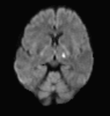 <strong> The very bright intensity in the above DWI indicates that this patient:</strong> A) has metastatic disease. B) had an acute ischemic stroke. C) has an AVM. D) has MS.