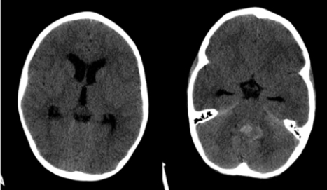 <strong> The axial CT images shown are two different slices from one study on a pediatric patient. Your likely diagnosis is:</strong> A) hemorrhagic stroke. B) obstructive hydrocephalus. C) subarachnoid hemorrhage. D) uncal herniation.