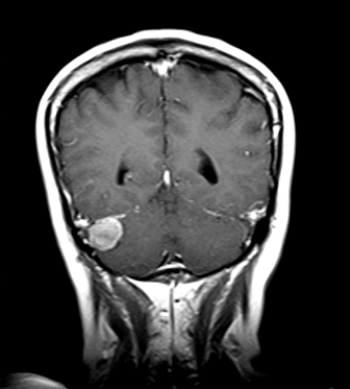 <strong> The patient in this image has:</strong> A) a meningioma. B) hydrocephalus. C) a cephalhematoma. D) uncal herniation.