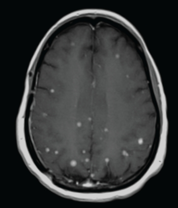 <strong> The above axial contrast-enhanced MRI is consistent with:</strong> A) dementia. B) metastatic breast cancer. C) Kuru. D) TIAs.