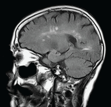 <strong> This sagittal T2 FLAIR MRI is consistent with:</strong> A) MS. B) ischemic stroke. C) primary brain tumor. D) pituitary adenoma.