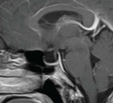 <strong> This sagittal contrast-enhanced T1 MRI shows a patient with:</strong> A) visual field defects. B) chronic headache and papilledema. C) lower extremity weakness. D) facial paresthesias.