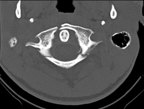 <strong> The image of this patient shows that the patient has what type of injury?</strong> A) Hangman's fracture B) Jefferson Burst fracture C) Herniated C2 disk D) C7 vertebral arch fracture