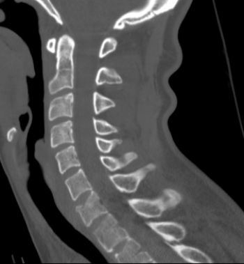 <strong> The patient in this image has which of the following?</strong> A) A fractured arch at C1 B) A fractured hyoid bone C) A vertebral body compression fracture D) A spinal metastatic disease