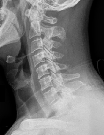 <strong> Which type of fracture(s) does the image indicate?</strong> A) Chance fracture B) Clay-shoveler's fracture C) Hangman's fracture D) Cervical facet fractures